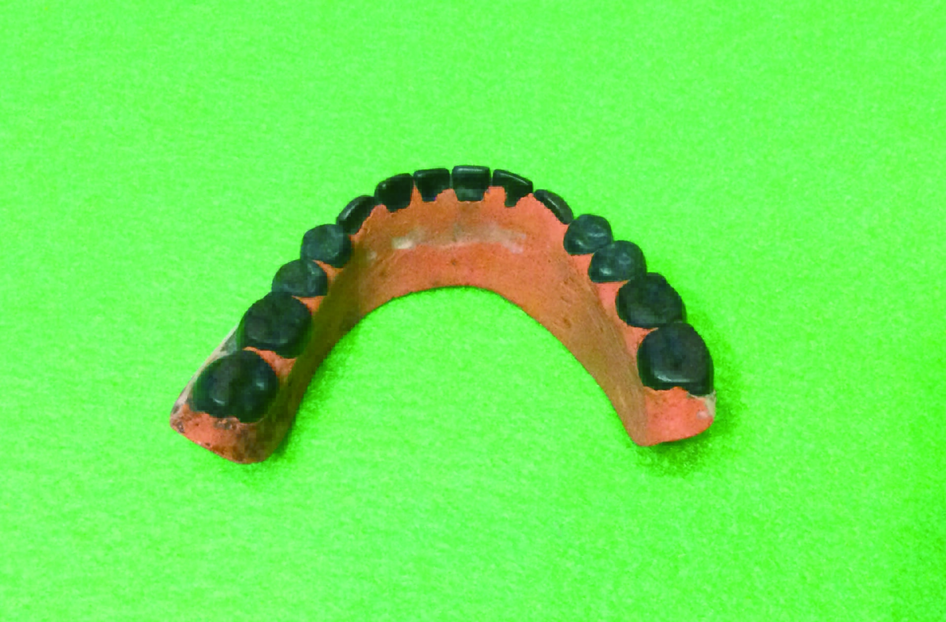 図４b　お歯黒陶歯のゴム床義歯舌側面