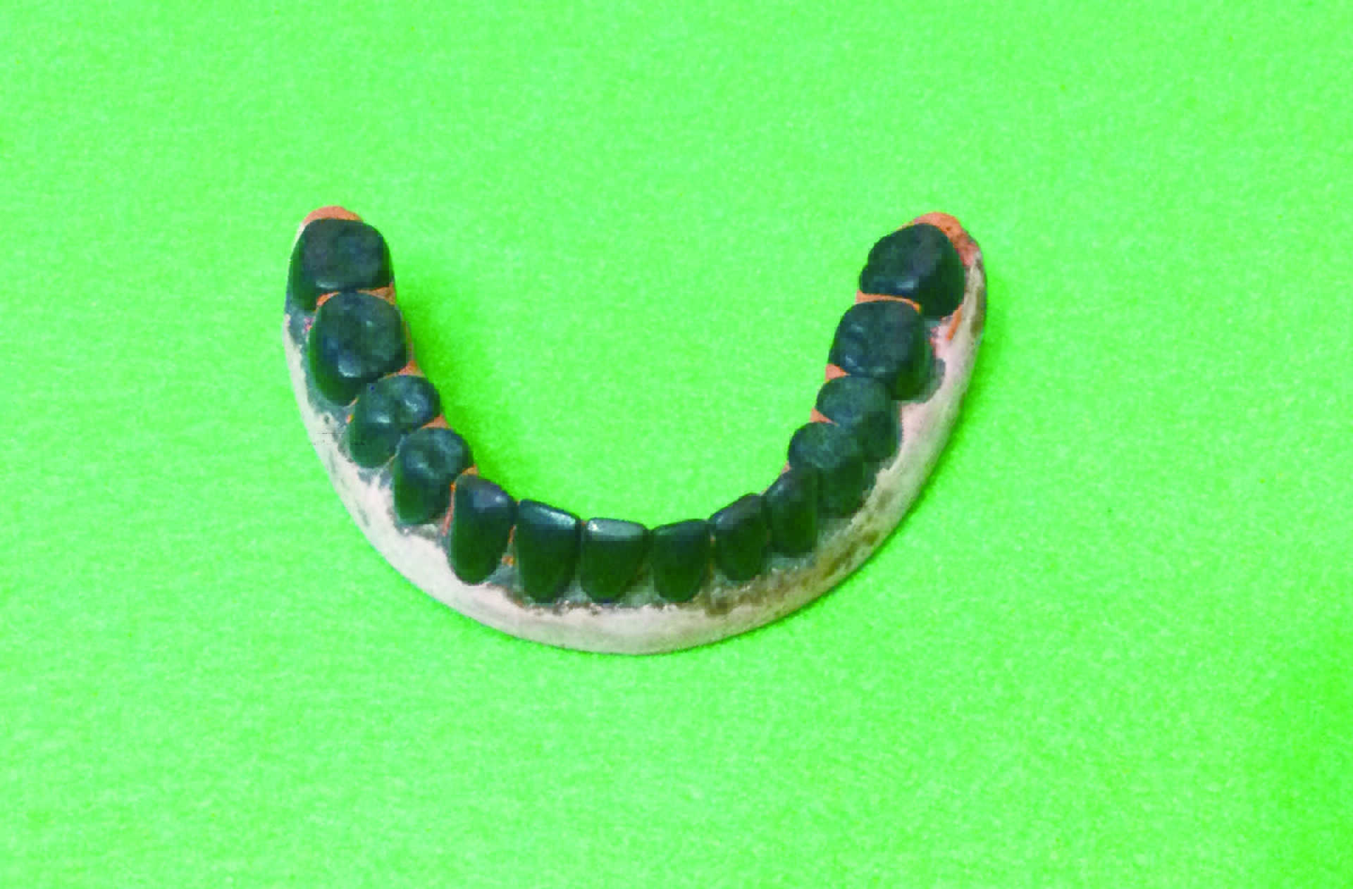 図４a　お歯黒陶歯のゴム床義歯