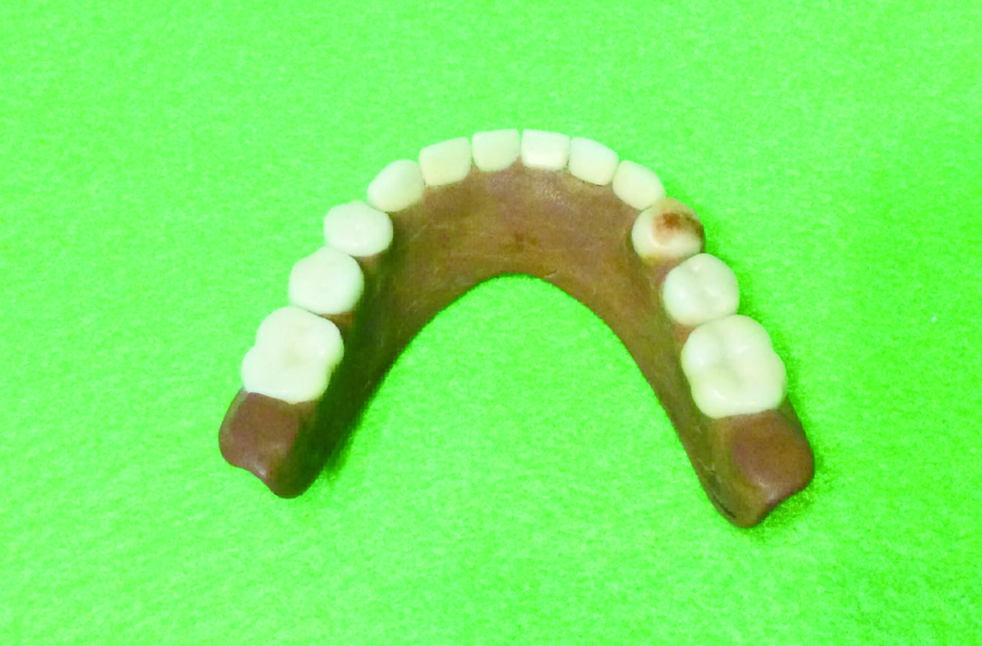 図７a　40年間使用されたゴム床義歯咬合面