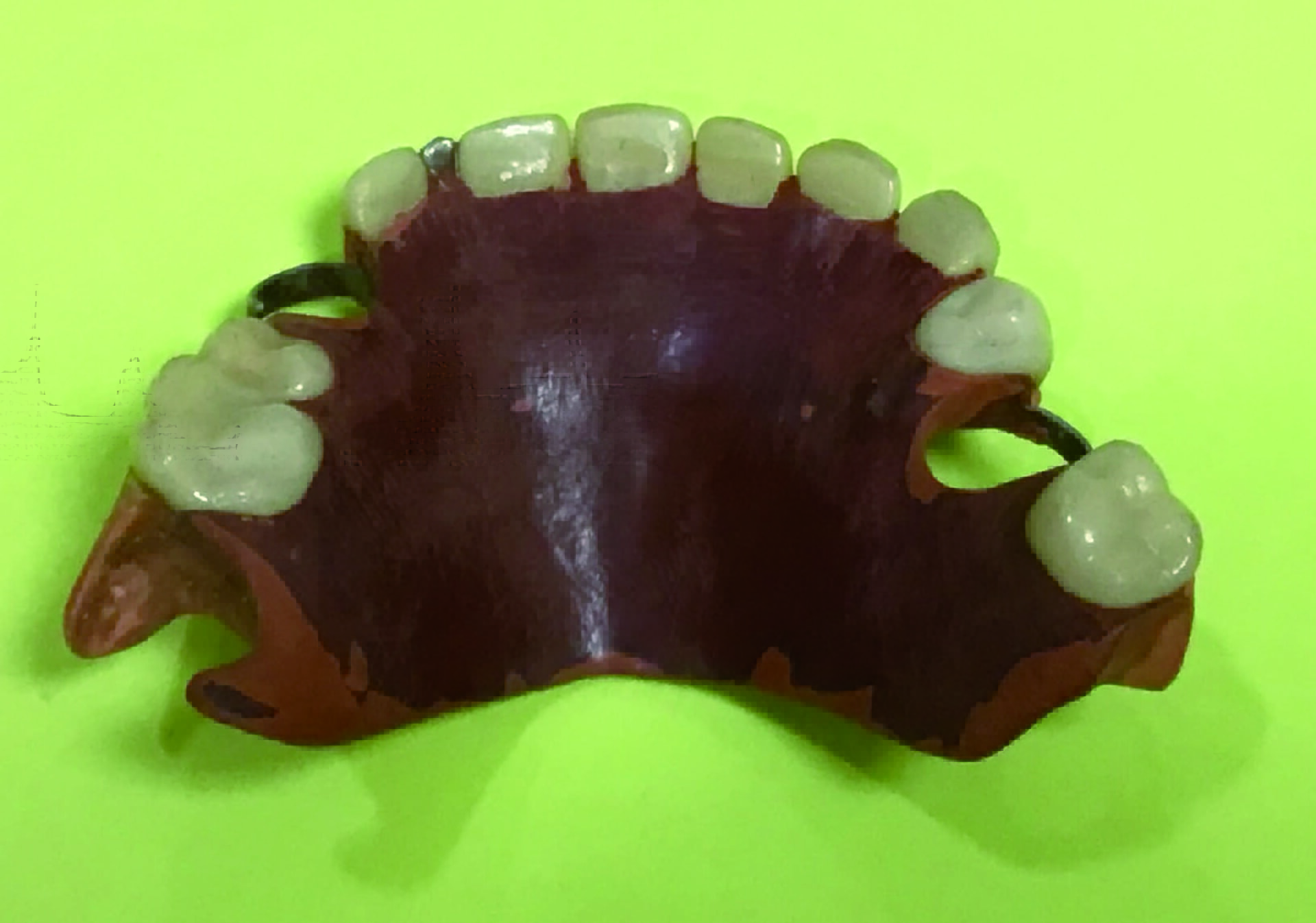 図10b　クラスプ有りゴム床義歯拡大図