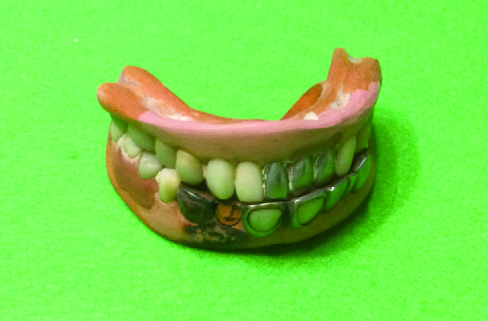 図６b　上下ゴム床義歯の咬合
