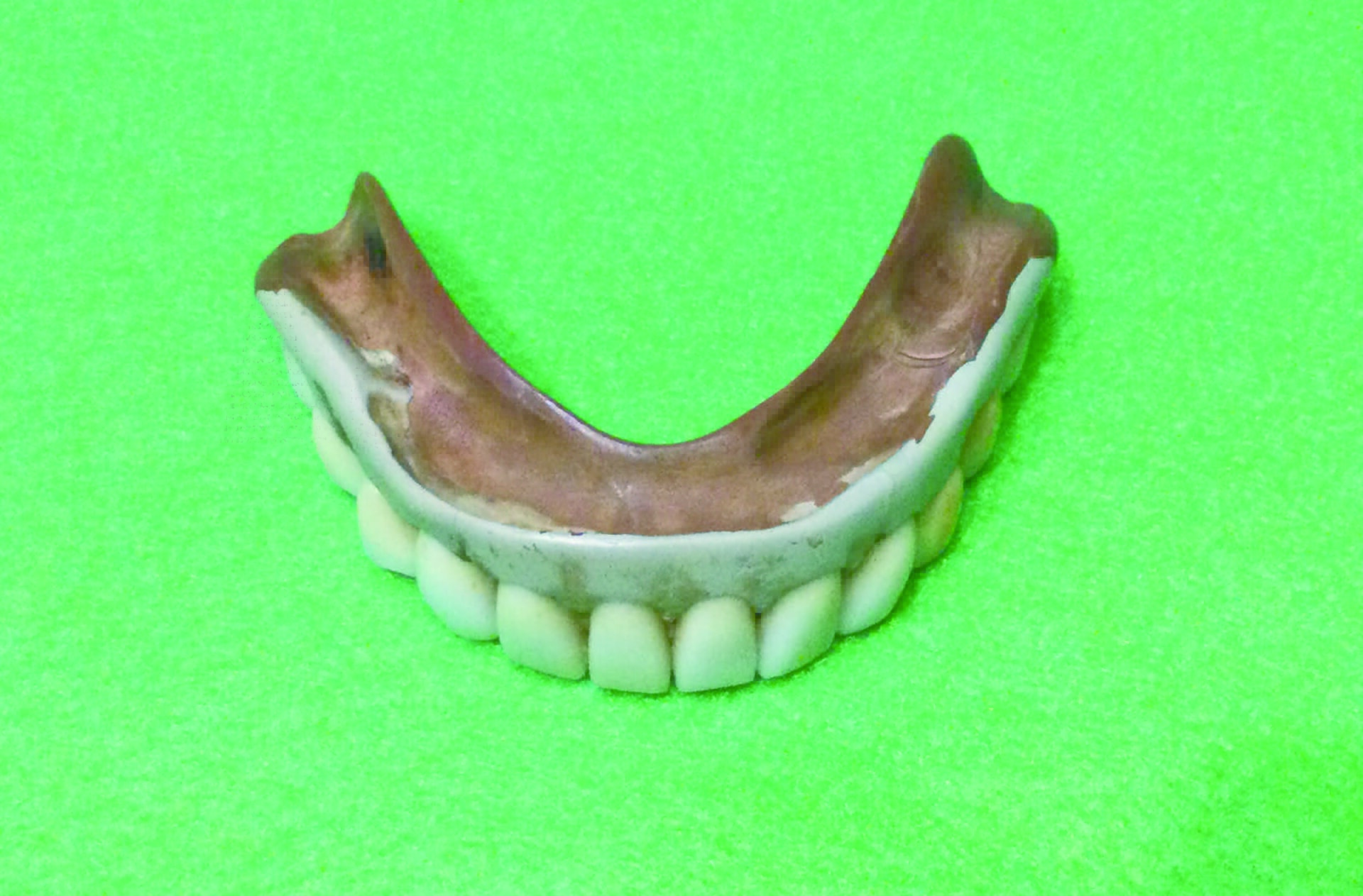 図７b　40年間使用されたゴム床義歯床内面